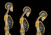 پوکی استخوان