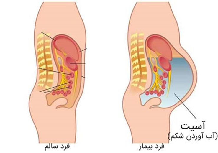 تشخیص و ارزیابی آسیت در سرطان معده