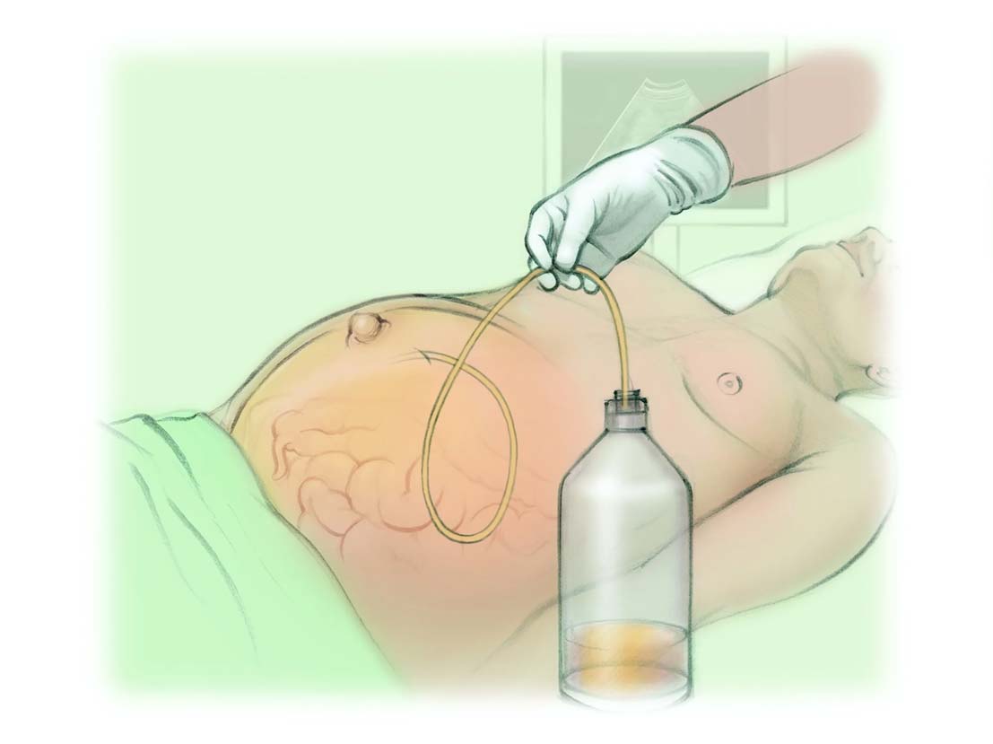 پاراسنتز (Paracentesis) و تحلیل مایع آسیت