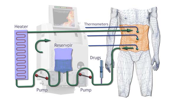 شیمی‌درمانی داخل صفاقی (Intraperitoneal Chemotherapy)